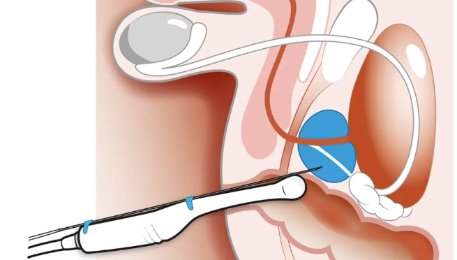 Ny enkät till patienter vars prostatabiopsier registreras i realtid i IPÖ eller i diagnostikmallen Biopsi.
